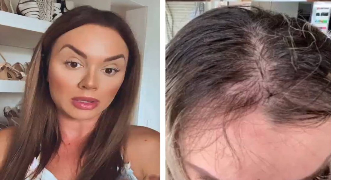 depressão causa queda de cabelo