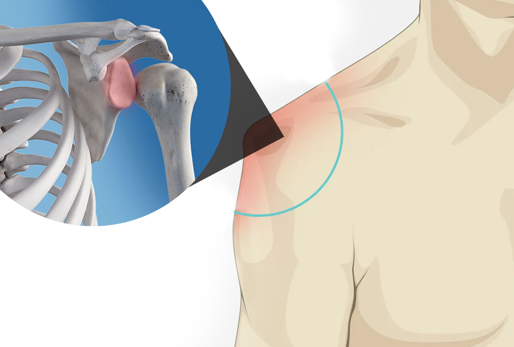 5 ideias de títulos:
1. Luxação de Ombro: Guia Completo de Primeiros Socorros e Tratamento Hospitalar
2. O Que Fazer Imediatamente ao Deslocar o Ombro: Dicas Essenciais
3. Riscos de Ignorar um Ombro Deslocado: Consequências a Longo Prazo
4. Do Pronto-Socorro à Fisioterapia: O Caminho da Recuperação do Ombro Deslocado
5. Como Evitar Novas Luxações: Prevenção e Cuidados Pós-Tratamento
