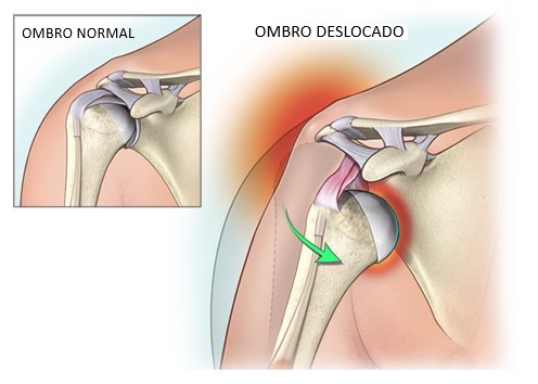 5 ideias de títulos:
1. Luxação de Ombro: Guia Completo de Primeiros Socorros e Tratamento Hospitalar
2. O Que Fazer Imediatamente ao Deslocar o Ombro: Dicas Essenciais
3. Riscos de Ignorar um Ombro Deslocado: Consequências a Longo Prazo
4. Do Pronto-Socorro à Fisioterapia: O Caminho da Recuperação do Ombro Deslocado
5. Como Evitar Novas Luxações: Prevenção e Cuidados Pós-Tratamento
