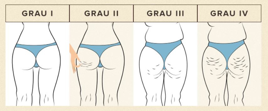 erros comuns ao tentar eliminar celulite