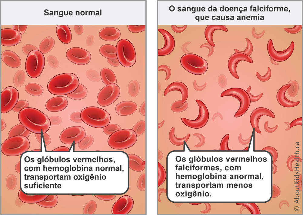 Traço Falciforme vs. Doença Falciforme: Qual a Diferença?