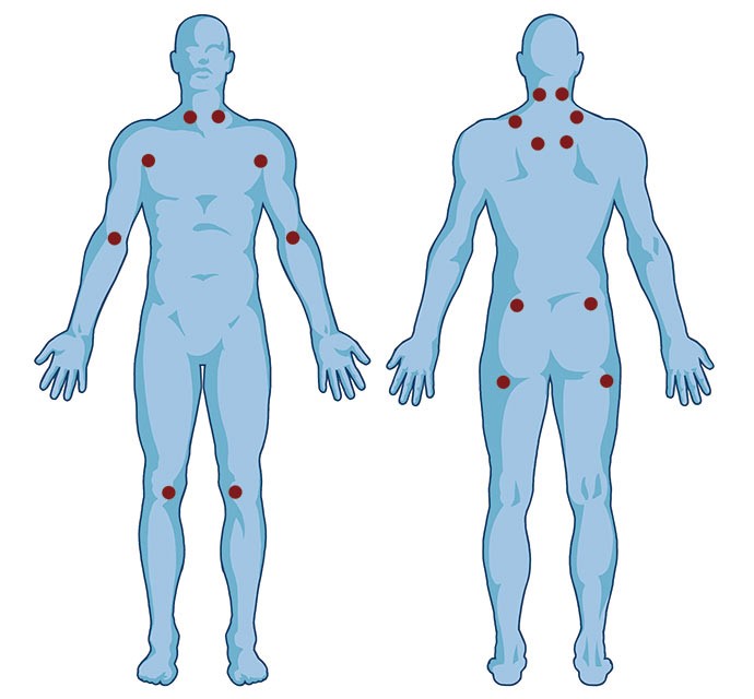 Fadiga e 'Fibrofog': Como a Fibromialgia Impacta o Dia a Dia