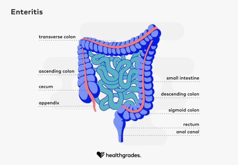 tratamento para inflamação no intestino delgado