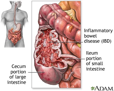 causas de desconforto intestinal agudo