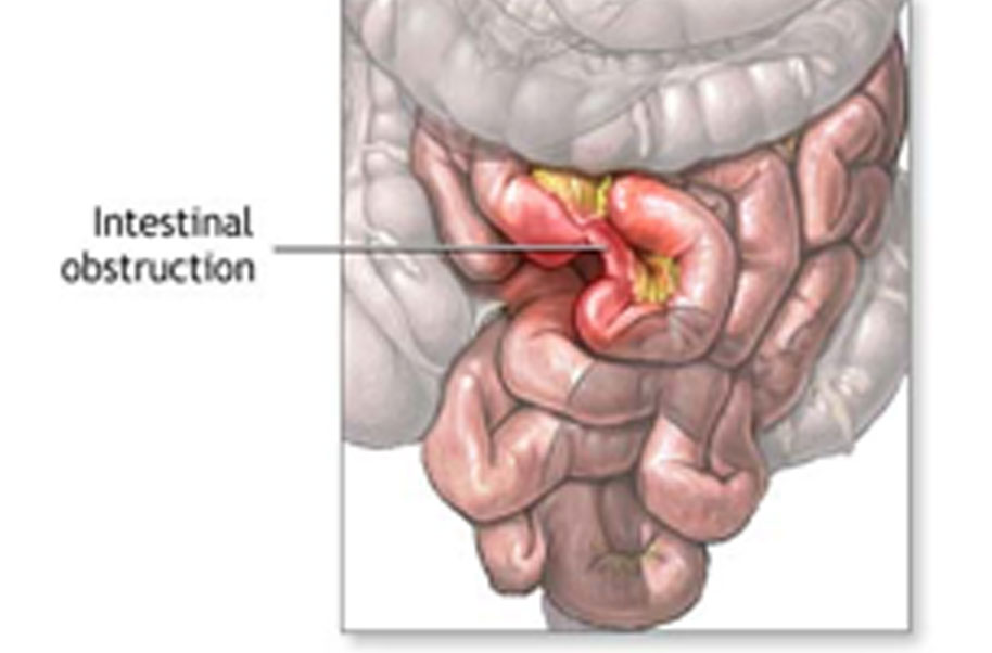 causas de desconforto intestinal agudo