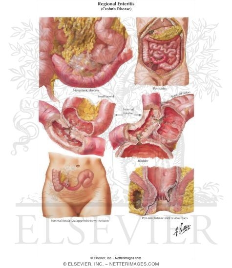 tratamento para inflamação no intestino delgado