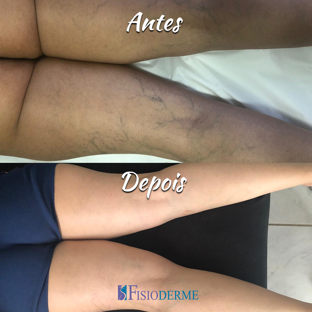 Quanto Custa a Escleroterapia a Laser? Entenda os Valores e Fatores