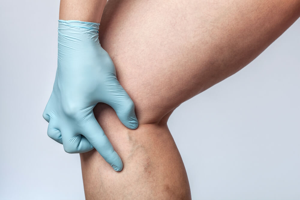 Laser para Vasinhos em Peles Retintas: Precauções e Cuidados Essenciais