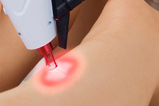 escleroterapia o laser