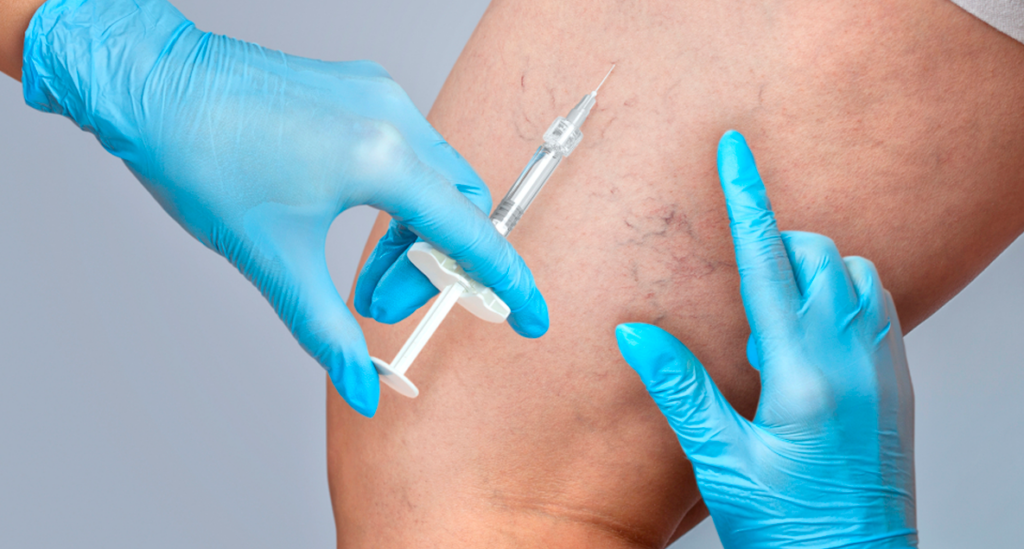 CLaCS: O Padrão-Ouro no Tratamento de Vasinhos e Varizes