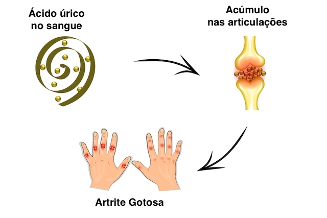 exame de acido urico