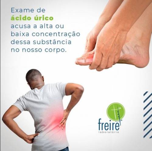 5 ideias de títulos:
1. Ácido Úrico: Entenda os Sintomas e a Importância do Exame.
2. Gota e Cálculos Renais: Como o Exame de Ácido Úrico Ajuda no Diagnóstico.
3. Preparo para o Exame de Ácido Úrico: Jejum e Coleta Explicados.
4. Valores de Referência do Ácido Úrico: O Que Significa Estar Acima ou Abaixo?
5. Ácido Úrico na Gravidez: Rastreamento de Pré-eclâmpsia.