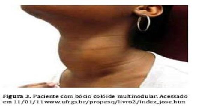 falta de iodo