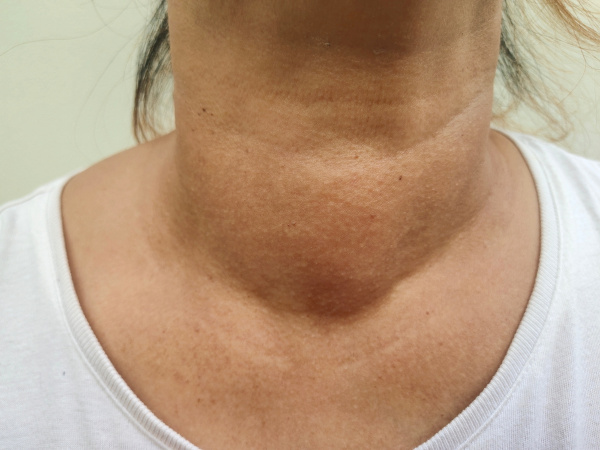 5 ideias de títulos:
1. Deficiência de Iodo: Os Perigos Silenciosos para a Saúde
2. Como a Falta de Iodo Afeta Seu Cérebro e Corpo
3. Guia Completo: Prevenção e Tratamento da Deficiência de Iodo
4. Iodo no Sal: A Medida Simples que Salva Vidas
5. Riscos da Deficiência de Iodo na Gravidez: Proteja Seu Bebê