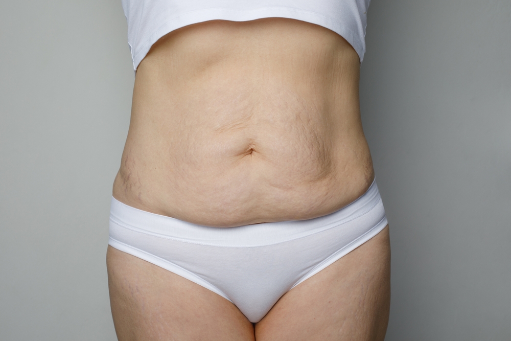 fibrose pos cirurgia