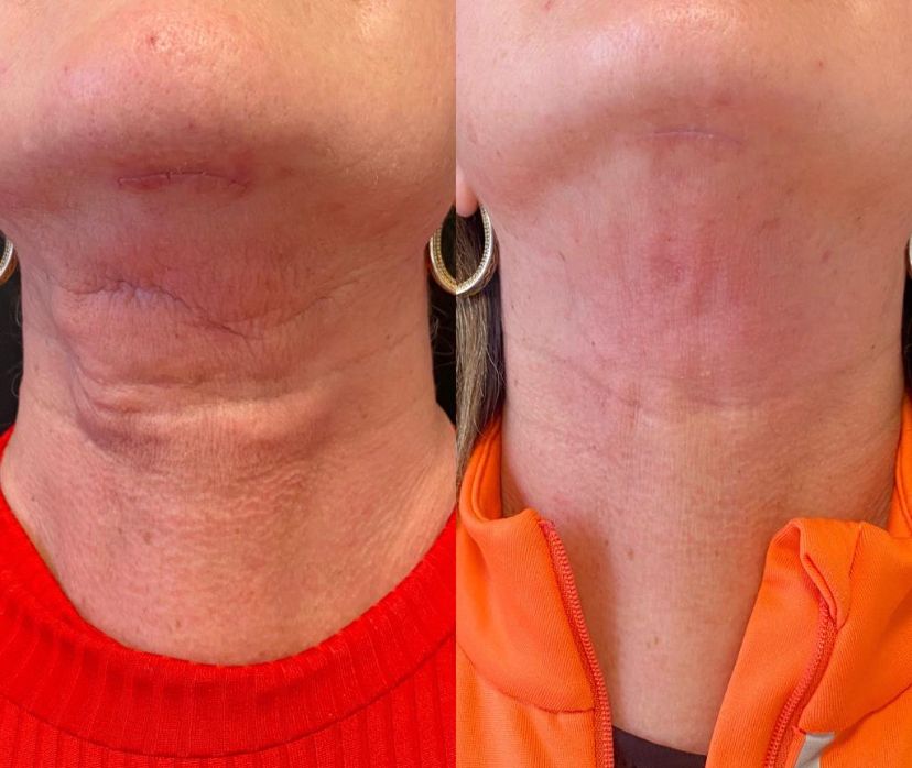 5 ideias de títulos:
1. Fibrose Pós-Cirúrgica: Entenda os Sintomas e Como Prevenir
2. Lipoaspiração e Abdominoplastia: Os Riscos da Fibrose e Soluções
3. Drenagem Linfática e Fisioterapia: Aliados no Combate à Fibrose
4. Fibrose: Quando se Preocupar e Como Agir no Pós-Operatório
5. Guia Completo: Prevenção e Tratamento da Fibrose Pós-Cirúrgica