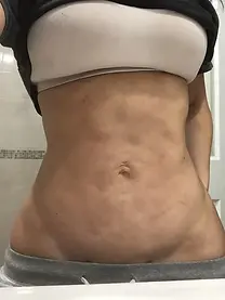 fibrose pos cirurgia