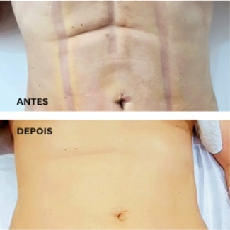 fibrose pos cirurgia
