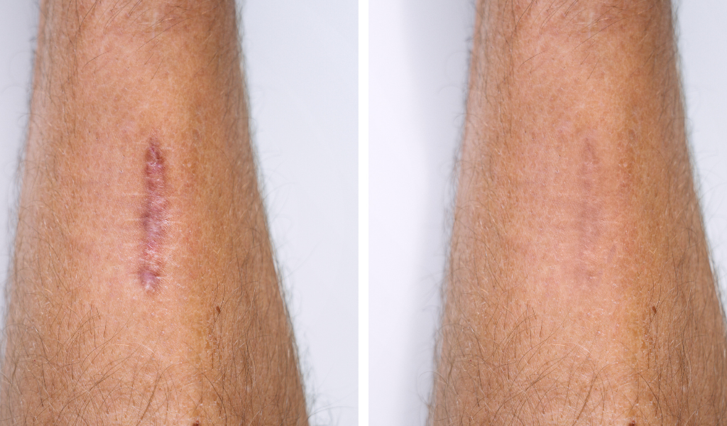 5 ideias de títulos:
1. Fibrose Pós-Cirúrgica: Entenda os Sintomas e Como Prevenir
2. Lipoaspiração e Abdominoplastia: Os Riscos da Fibrose e Soluções
3. Drenagem Linfática e Fisioterapia: Aliados no Combate à Fibrose
4. Fibrose: Quando se Preocupar e Como Agir no Pós-Operatório
5. Guia Completo: Prevenção e Tratamento da Fibrose Pós-Cirúrgica