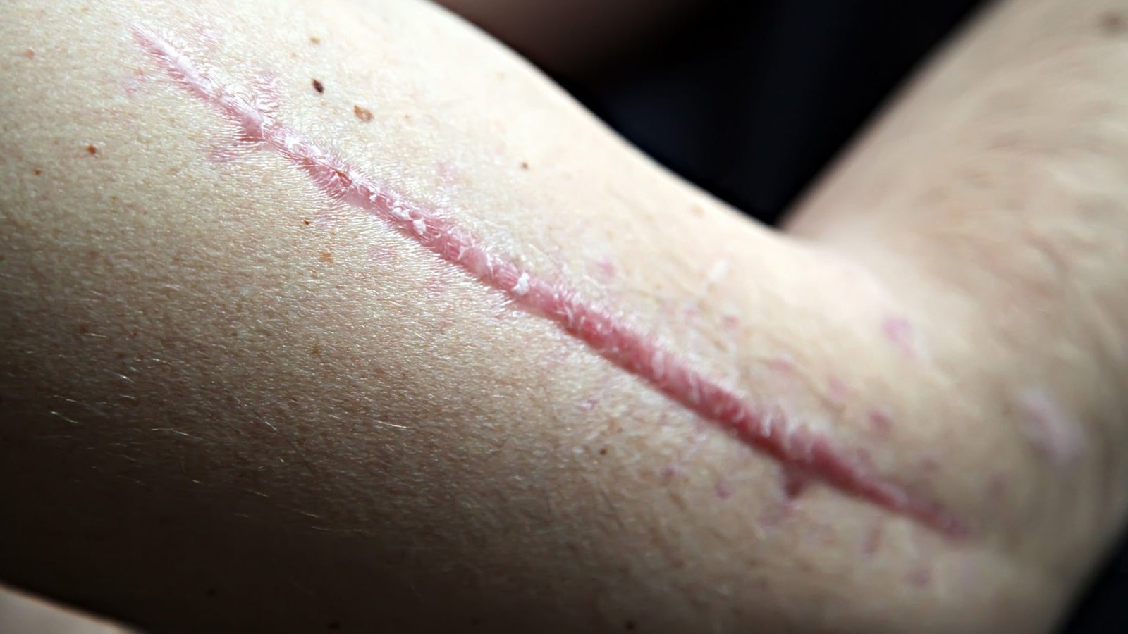 fibrose pos cirurgia