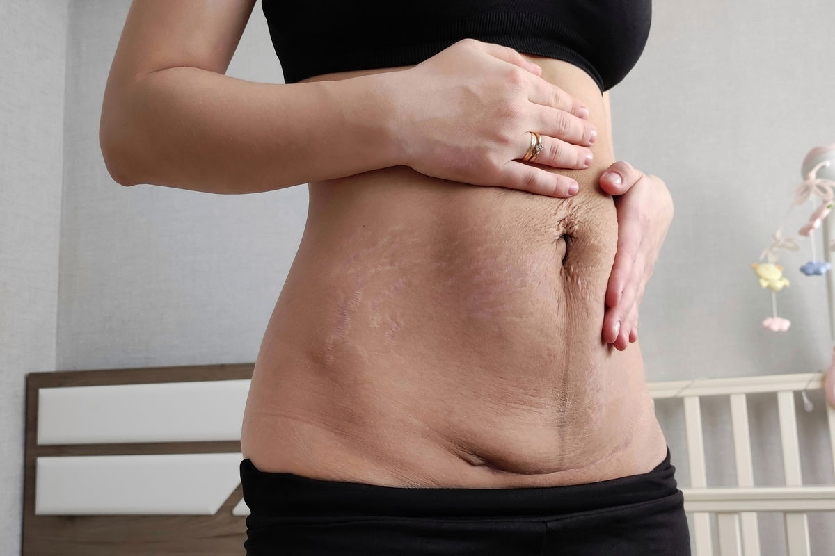 fibrose pos cirurgia