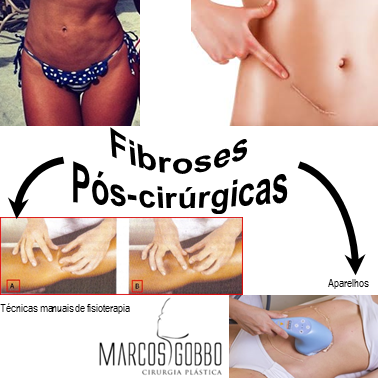 5 ideias de títulos:
1. Fibrose Pós-Cirúrgica: Entenda os Sintomas e Como Prevenir
2. Lipoaspiração e Abdominoplastia: Os Riscos da Fibrose e Soluções
3. Drenagem Linfática e Fisioterapia: Aliados no Combate à Fibrose
4. Fibrose: Quando se Preocupar e Como Agir no Pós-Operatório
5. Guia Completo: Prevenção e Tratamento da Fibrose Pós-Cirúrgica