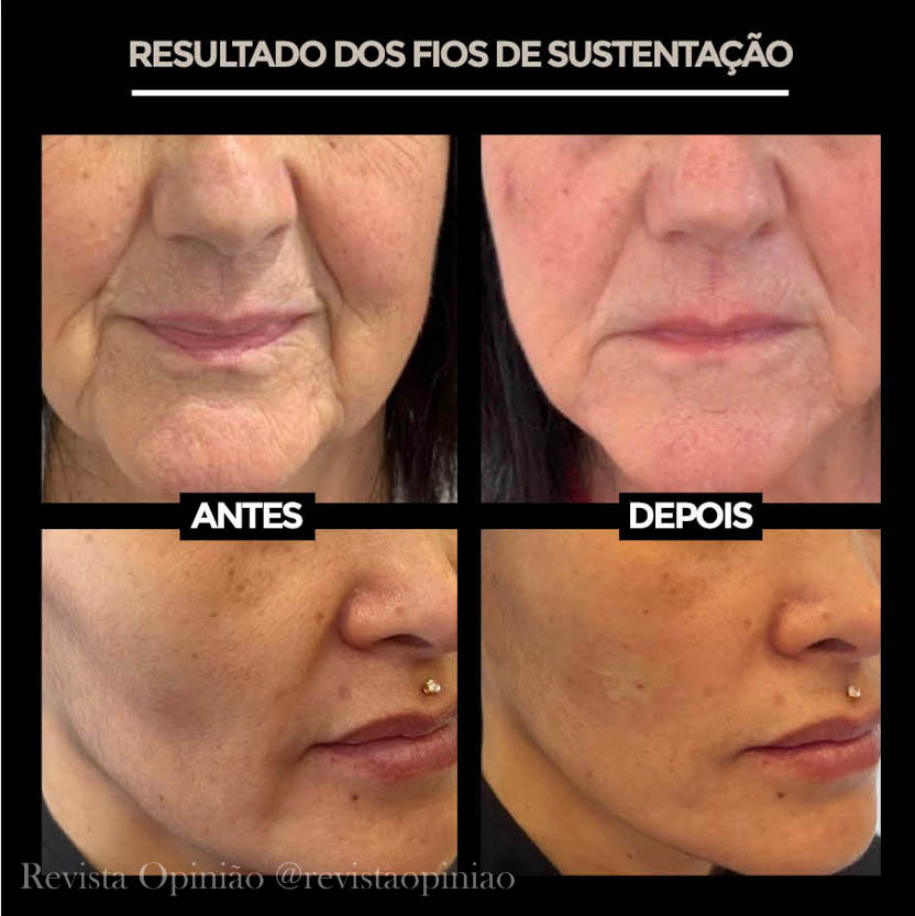 Fios de Seda Tópicos vs. Fios de Sustentação: Qual o Melhor para Você?