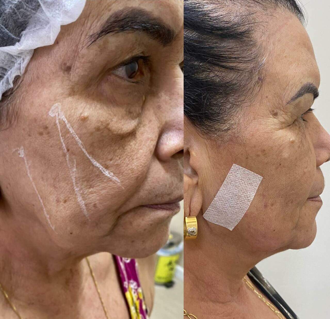 Fios de PDO: Entenda o Procedimento