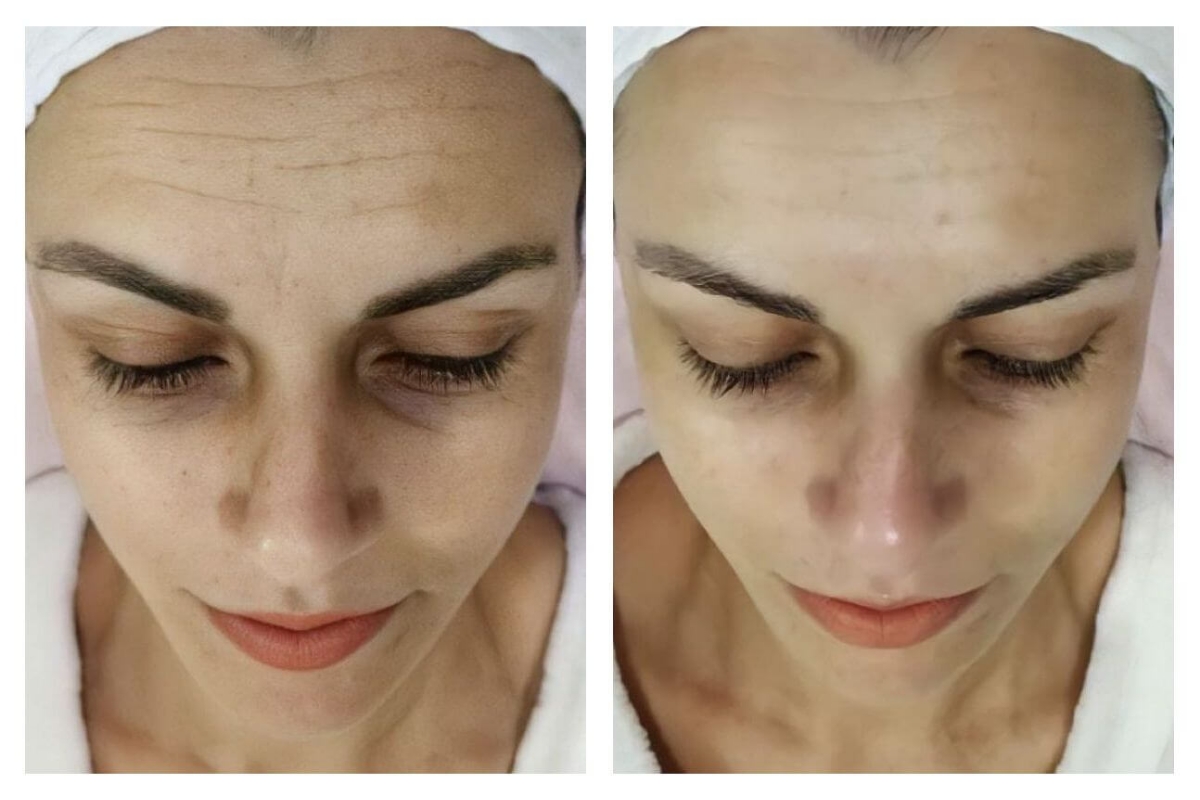 Guia Completo: Como Aplicar Fios de Proteína em Casa para Rejuvenescimento