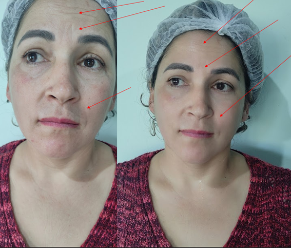 Fios de PDO: Entenda o Procedimento