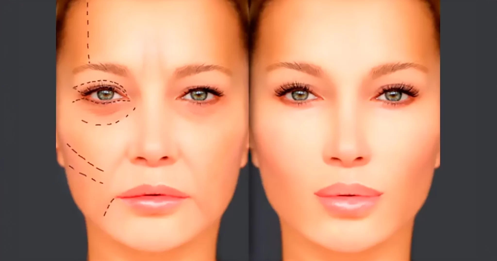 Onde Comprar Kits de Fios de Seda para Tratamento Facial e Quanto Custa?