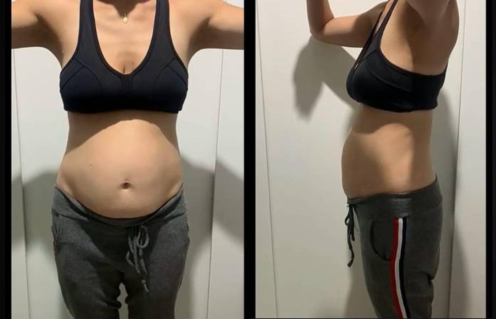 fotos de barriga com diástase antes e depois