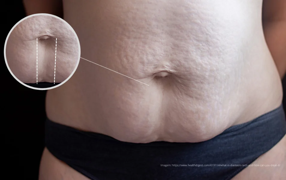 como saber se tenho diástase abdominal