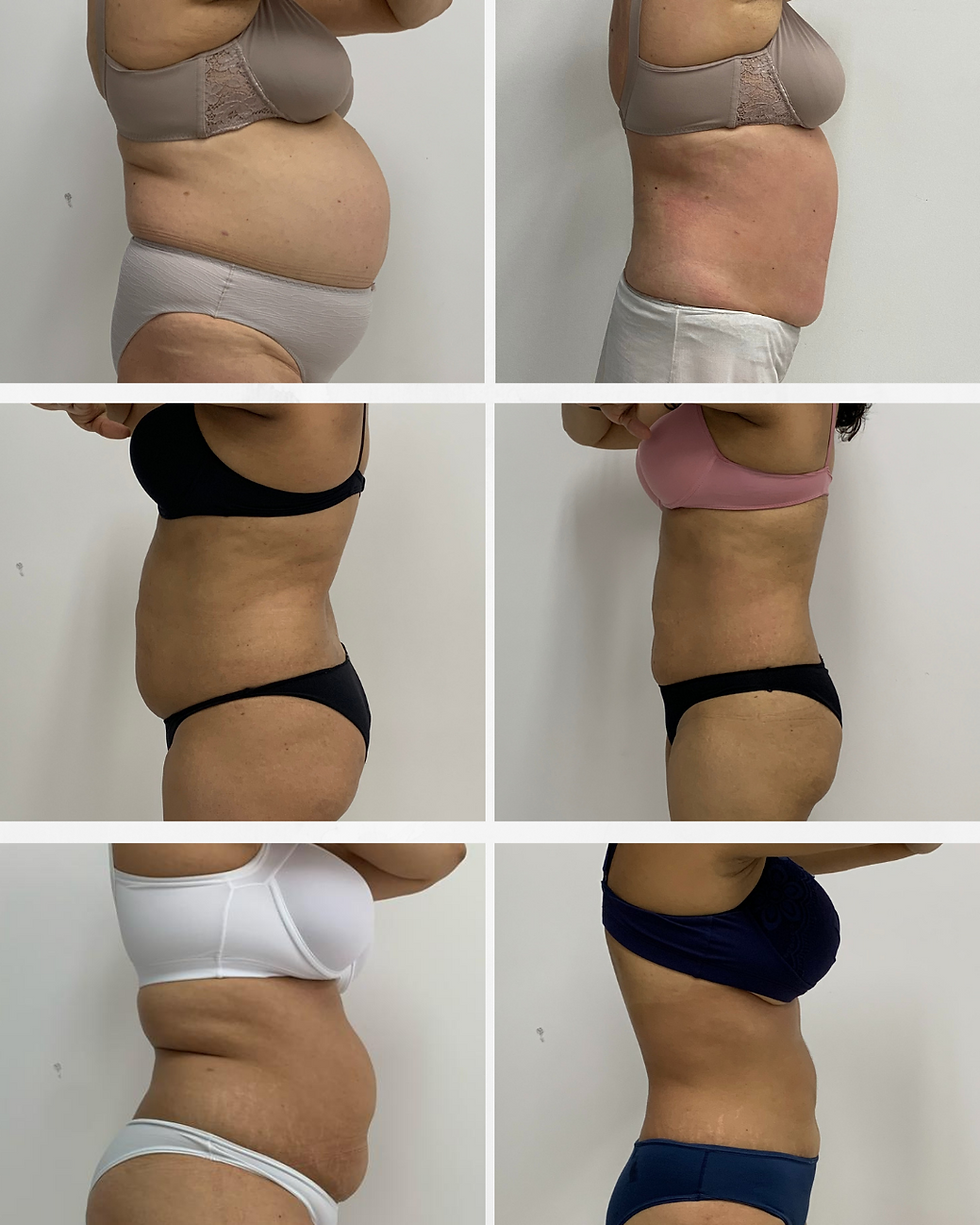 exercícios para fechar diástase