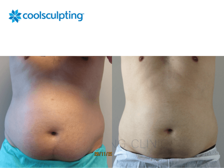 gelo na barriga antes e depois