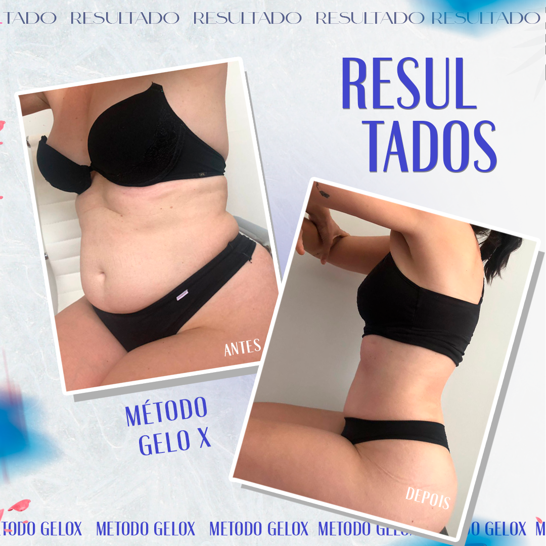 Criolipólise: Tudo sobre o procedimento e resultados