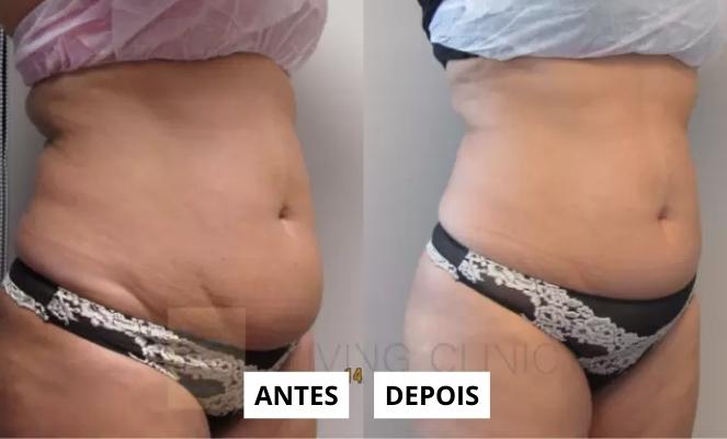 Diferenças entre Criolipólise Profissional e Caseira