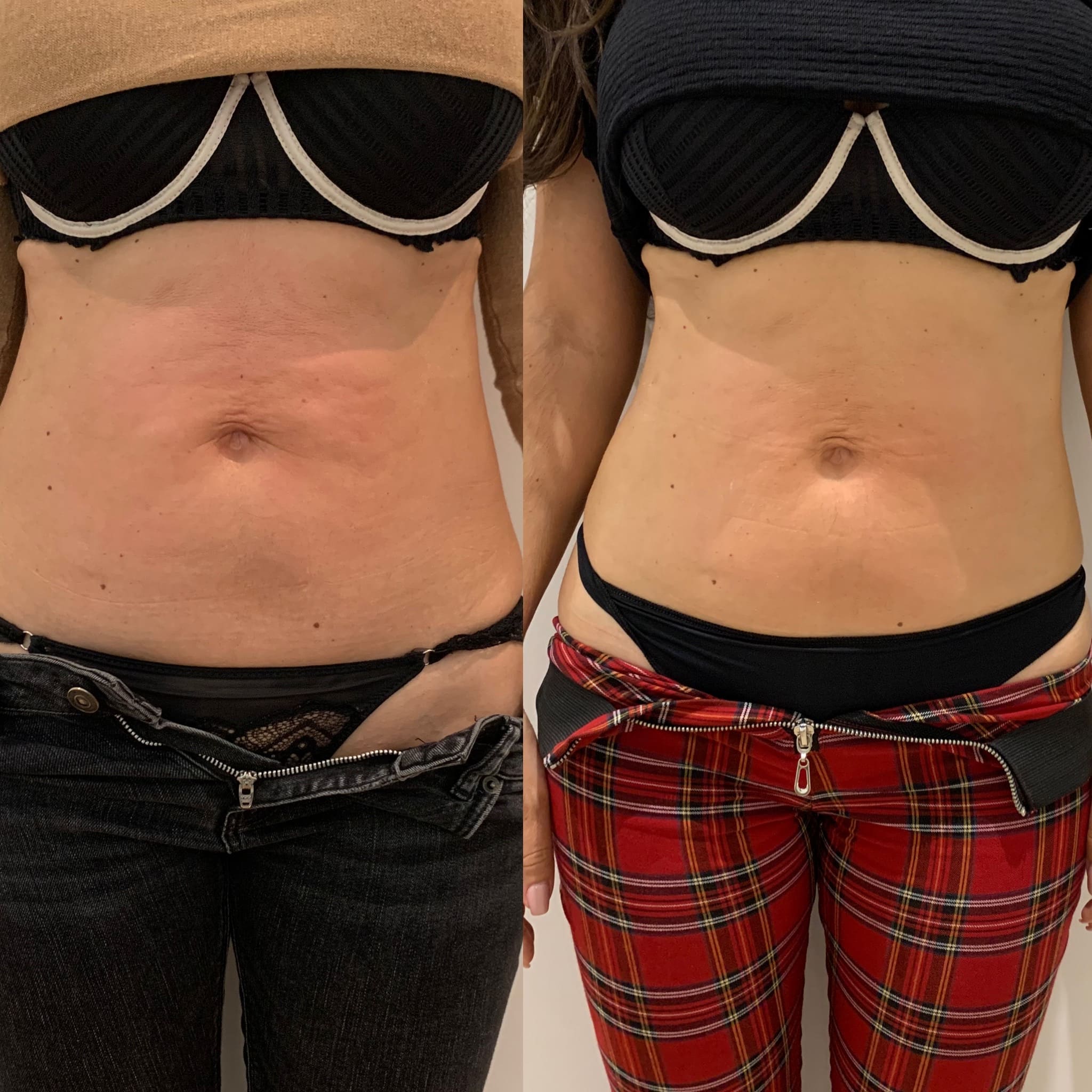 O que é Criolipólise e como funciona?