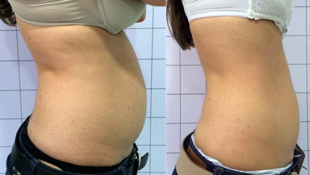 Criolipólise: Tudo sobre o procedimento e resultados