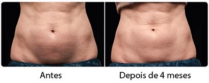 Riscos e Mitos do Gelo na Barriga