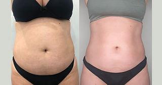 Quanto custa a Criolipólise: Preços e onde fazer