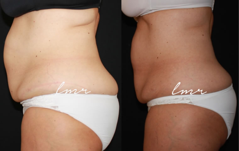 O que é Criolipólise e como funciona?