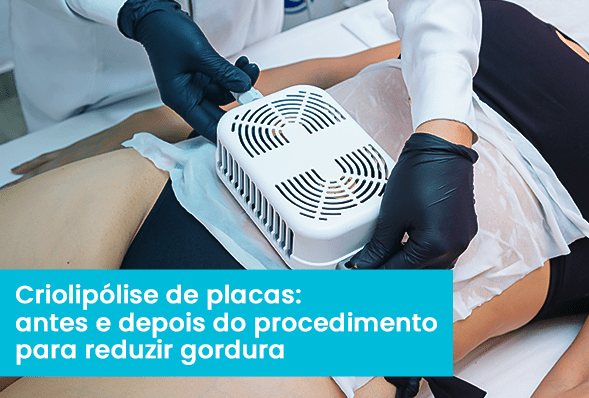 O que é Criolipólise e como funciona?
