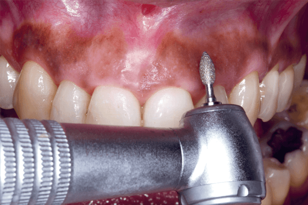 5 ideias de títulos:
1. Gengiva Marrom: Entenda as Causas Naturais e as que Exigem Atenção
2. Melanogengiva: O Que É e Como Tratar Manchas Escuras na Gengiva
3. Tártaro e Medicamentos: Como Eles Podem Escurecer Sua Gengiva?
4. Quando a Gengiva Marrom é um Sinal de Alerta? Procure um Dentista!
5. Procedimentos Estéticos para Gengiva Escura: Peeling e Clareamento