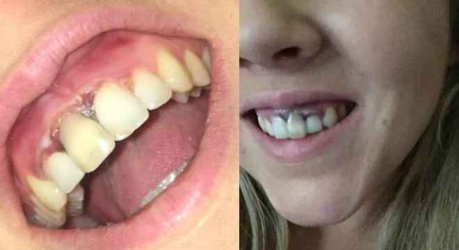 5 ideias de títulos:
1. Gengiva Marrom: Entenda as Causas Naturais e as que Exigem Atenção
2. Melanogengiva: O Que É e Como Tratar Manchas Escuras na Gengiva
3. Tártaro e Medicamentos: Como Eles Podem Escurecer Sua Gengiva?
4. Quando a Gengiva Marrom é um Sinal de Alerta? Procure um Dentista!
5. Procedimentos Estéticos para Gengiva Escura: Peeling e Clareamento