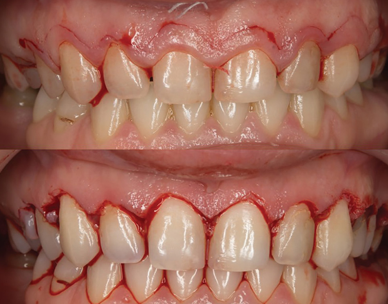 gengivoplastia cicatrização