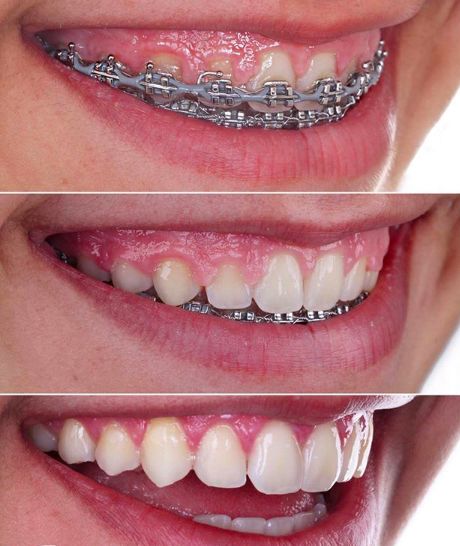 O que é Gengivoplastia e Para Quem é Indicada?