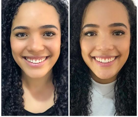 Como Lidar com o Desconforto Pós-Gengivoplastia