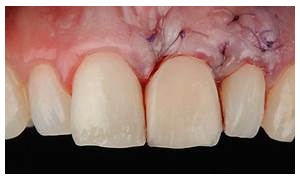 Guia Completo de Cuidados Pós-Operatórios da Gengivoplastia