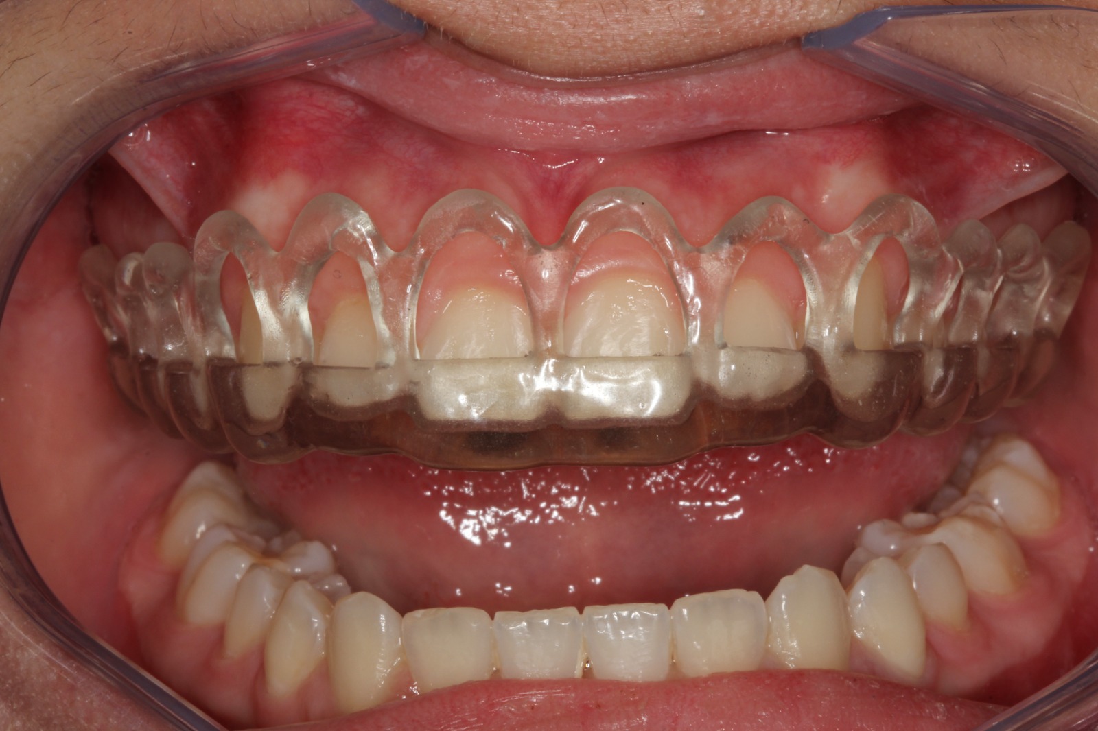 Mitos e Verdades sobre a Recuperação da Gengivoplastia